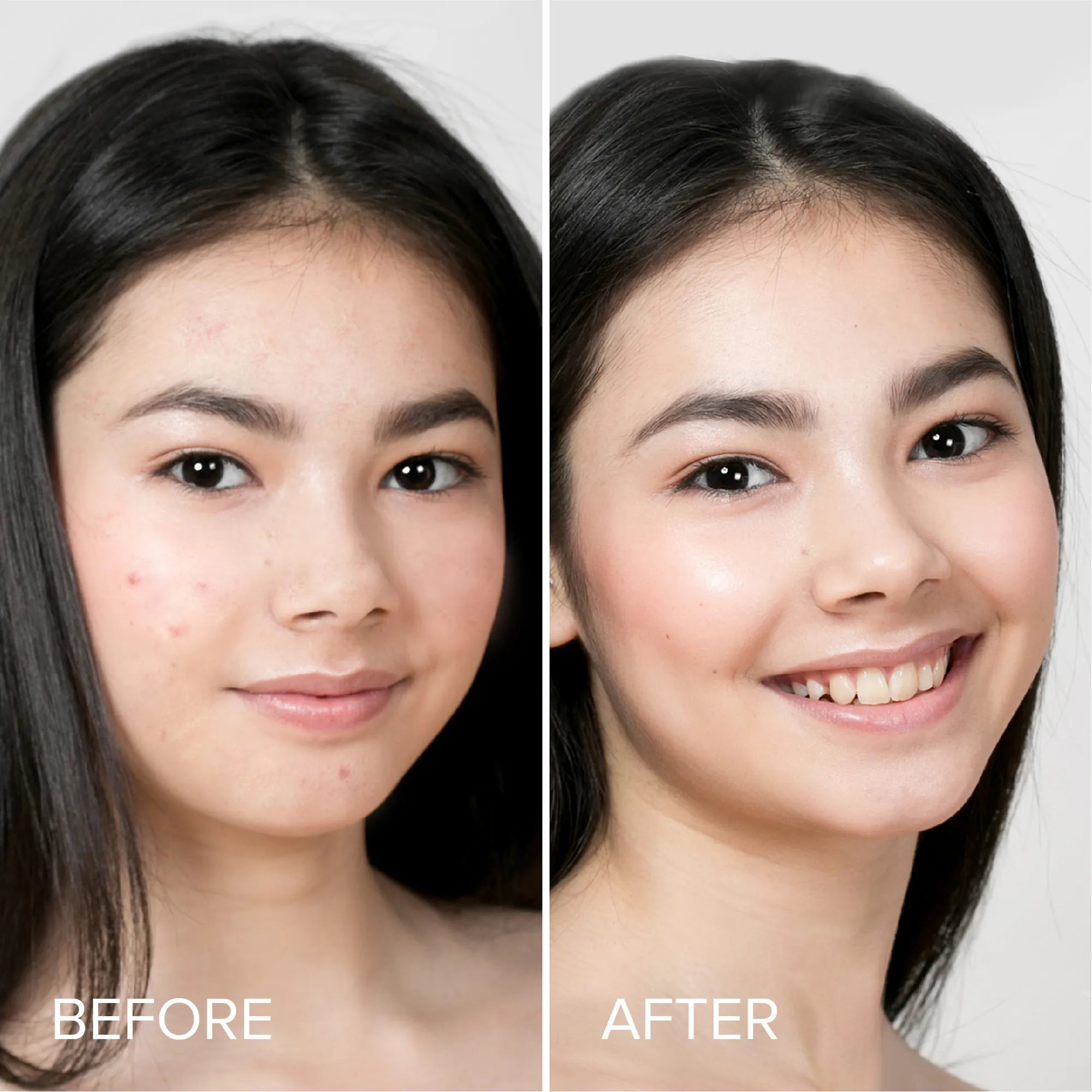Maree Pimple & Acne Patches