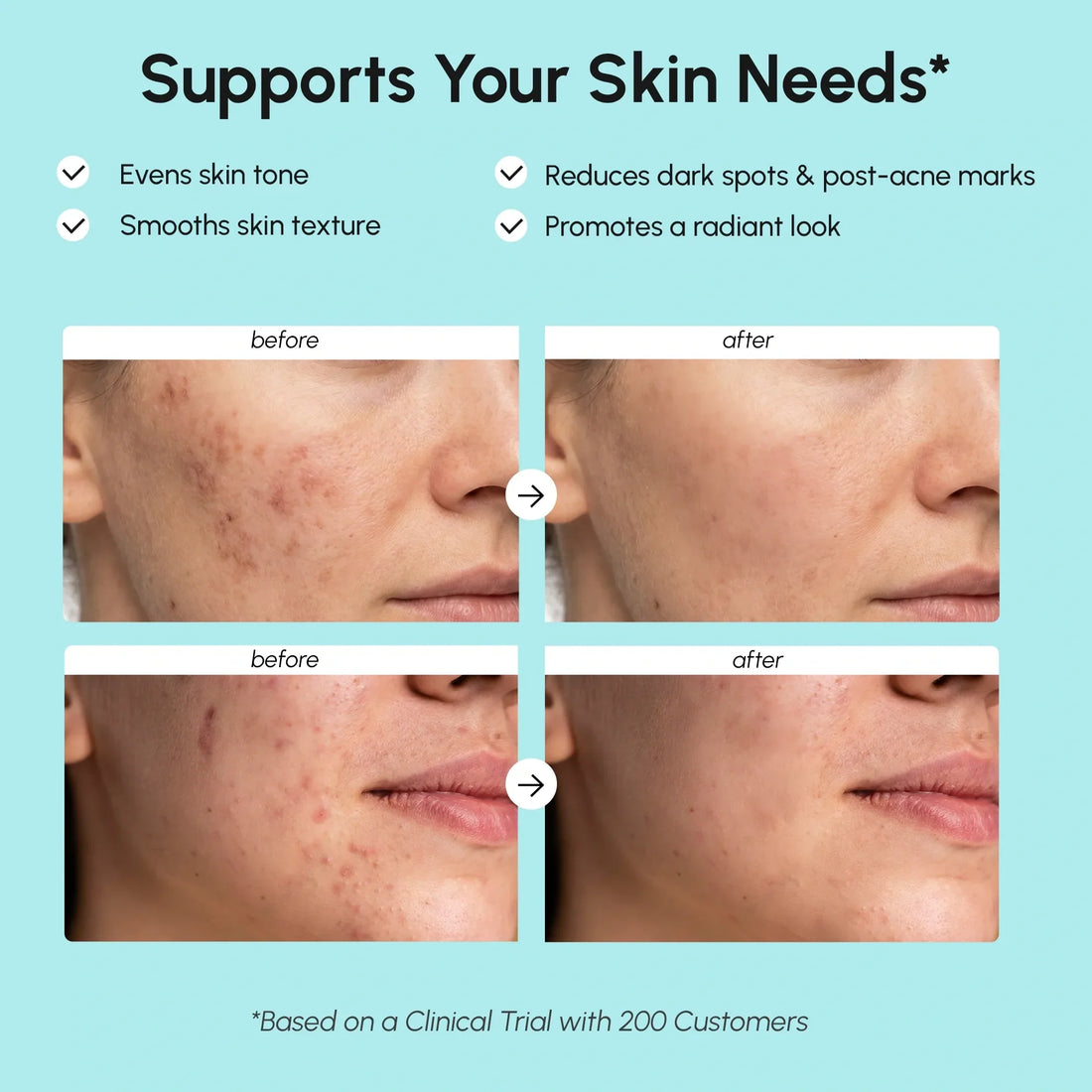 Marée® Azelaic Acid Cream for Sensitive Skin